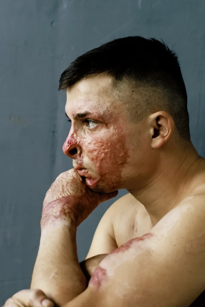 «Неопалимі» допомогли вже сотням ветеранів і полонених: як працює ініціатива з відновлення після травм війни 14 «Неопалимі» допомогли вже сотням ветеранів і полонених: як працює ініціатива з відновлення після травм війни